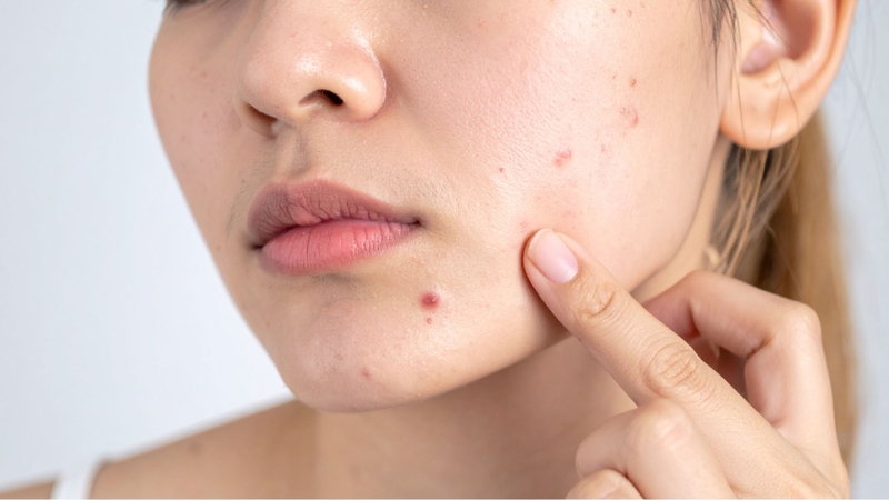 Mụn đinh râu thường xuất hiện đơn lẻ, sưng cứng và đau rõ rệt khi chạm vào