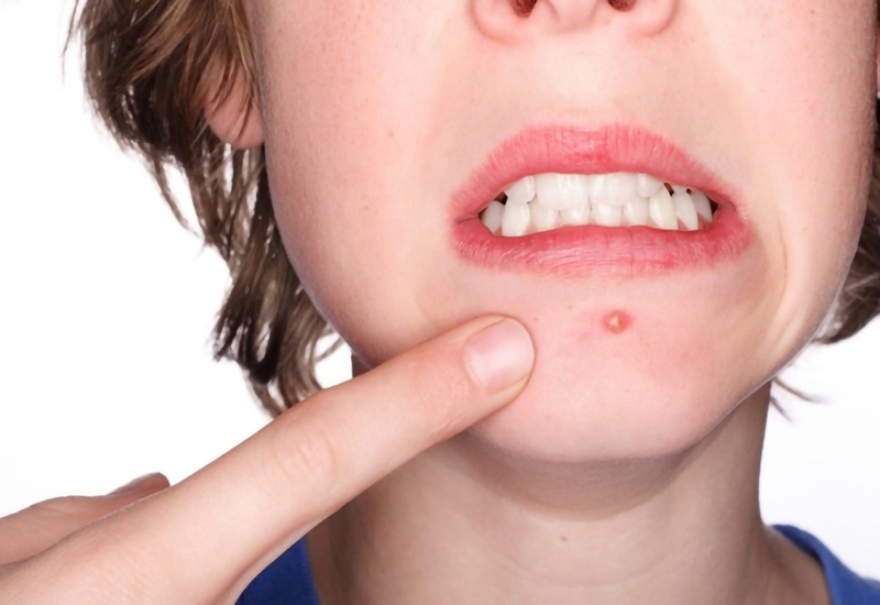 Mụn đinh râu sử dụng những loại kháng sinh nào?