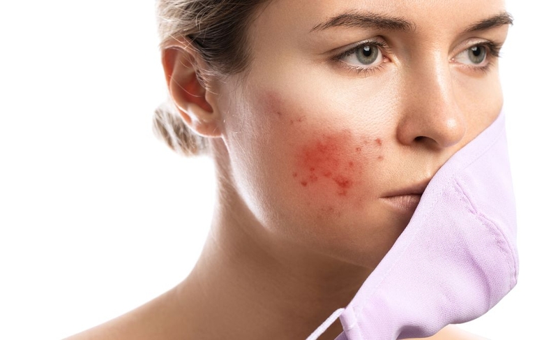 Mụn đỏ​: Nguyên nhân và cách điều trị hiệu quả 2