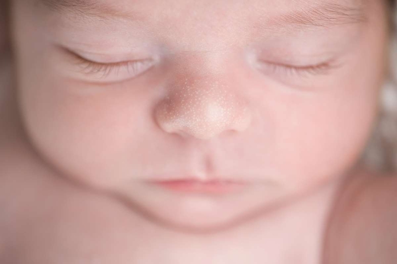 Mụn hạt kê: Nhận biết, nguyên nhân và cách chăm sóc trẻ tại nhà 1