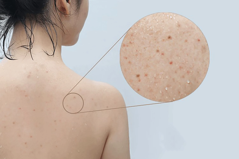 Mụn lưng có tự hết không và phòng ngừa như thế nào? 1
