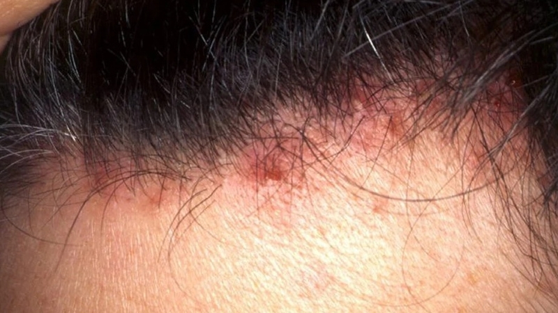 Nguyên nhân, cách khắc phục và ngăn ngừa mụn mọc ở trán gần chân tóc 1