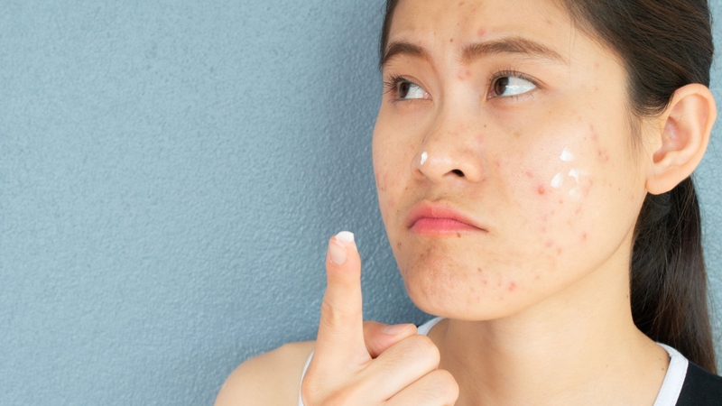 Mụn mủ bị vỡ phải làm sao?