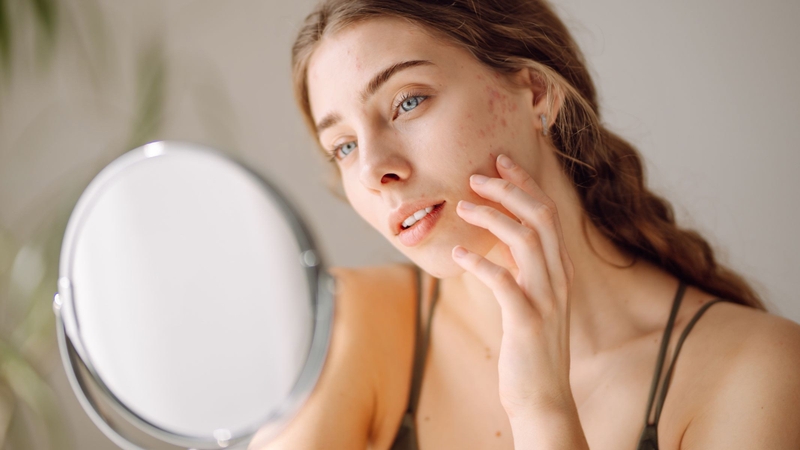 Dùng mỹ phẩm không phù hợp làm da yếu đi, khiến mụn viêm dễ tổn thương và vỡ