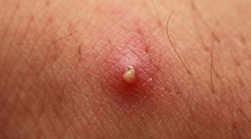 Những điều cần biết về vùng kín nổi mụn trắng ngứa 1