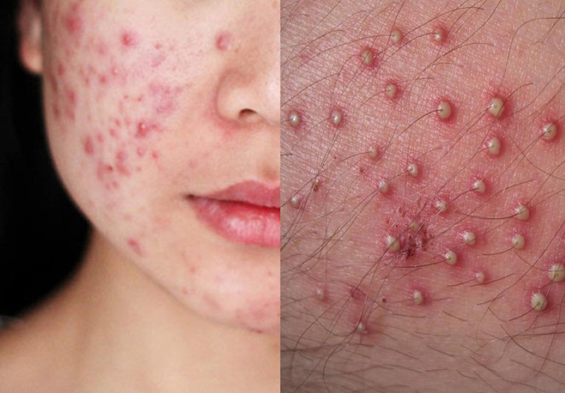 Mụn nấm men là gì? Đối tượng nào dễ bị mụn này? 5