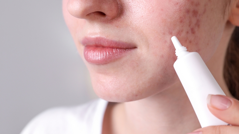 Mụn nang có tự hết không? Những điều bạn cần biết để xử lý đúng cách 3