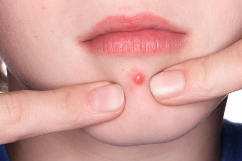 Mụn nhọt không có đầu: Nguyên nhân, triệu chứng và cách phòng ngừa 1