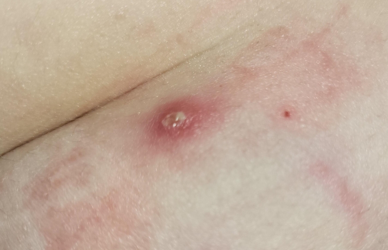 Mụn nhọt ở bụng: Nguyên nhân, dấu hiệu nhận biết và cách điều trị 1