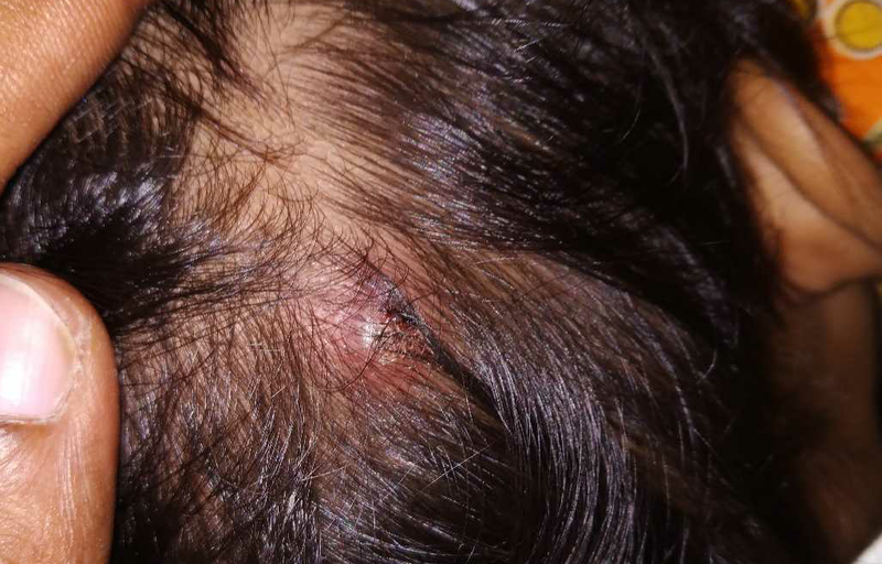 Mụn nhọt ở đầu: Nguyên nhân, triệu chứng, cách điều trị 2