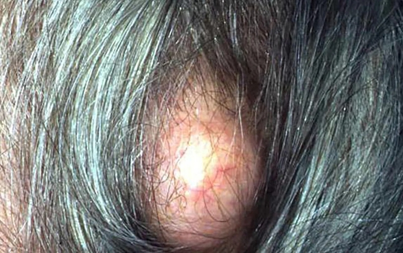 Mụn nhọt ở đầu: Nguyên nhân, triệu chứng, cách điều trị 3