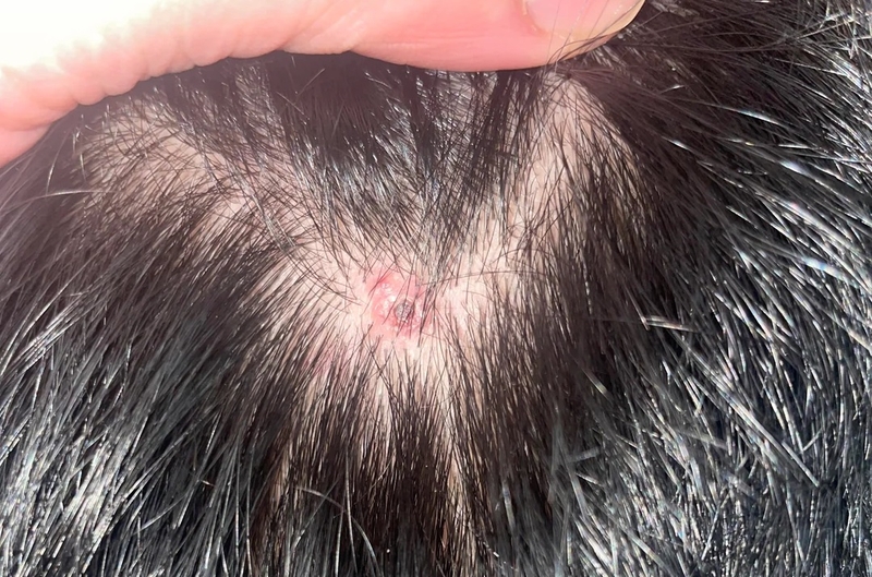 Mụn nhọt ở đầu: Nguyên nhân, triệu chứng, cách điều trị 4