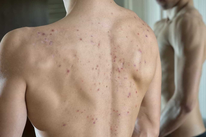 Nguyên nhân gây mụn nhọt ở lưng và cách điều trị 3