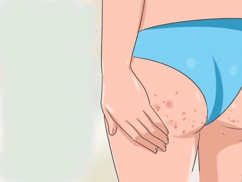 Mụn nhọt ở mông là do đâu có nên nặn không