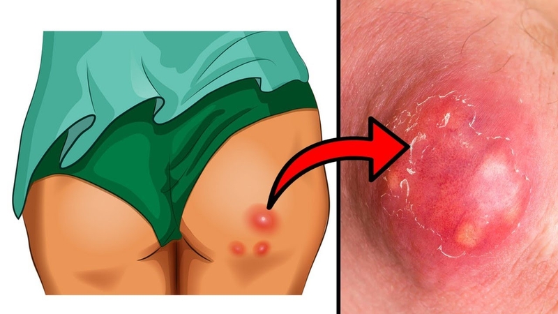 Mụn nhọt ở mông sưng to đau nhức cần xử lý thế nào 1
