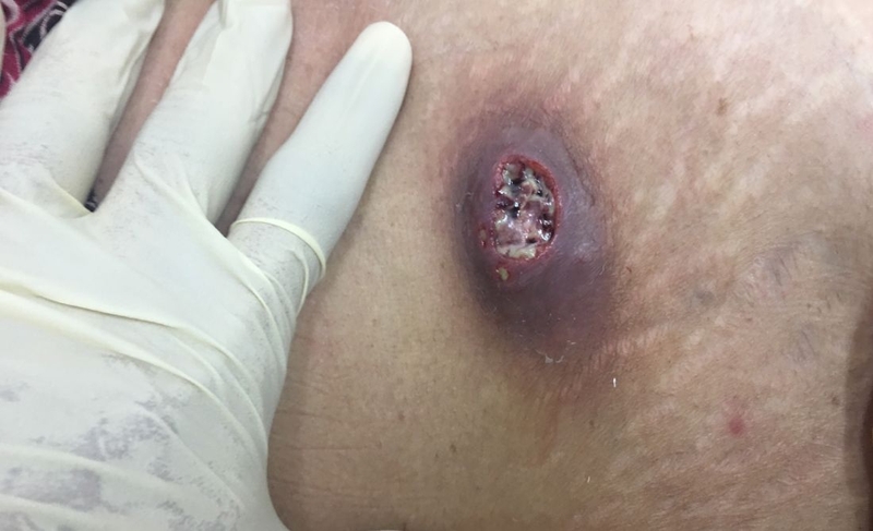 Mụn nhọt ở bụng: Nguyên nhân, dấu hiệu nhận biết và cách điều trị 3