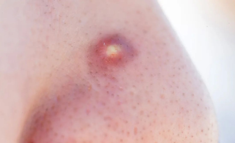 Nên làm gì khi bị mụn nhọt ở mũi 1