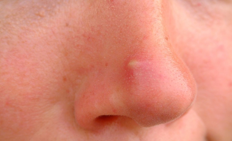 Nên làm gì khi bị mụn nhọt ở mũi 2