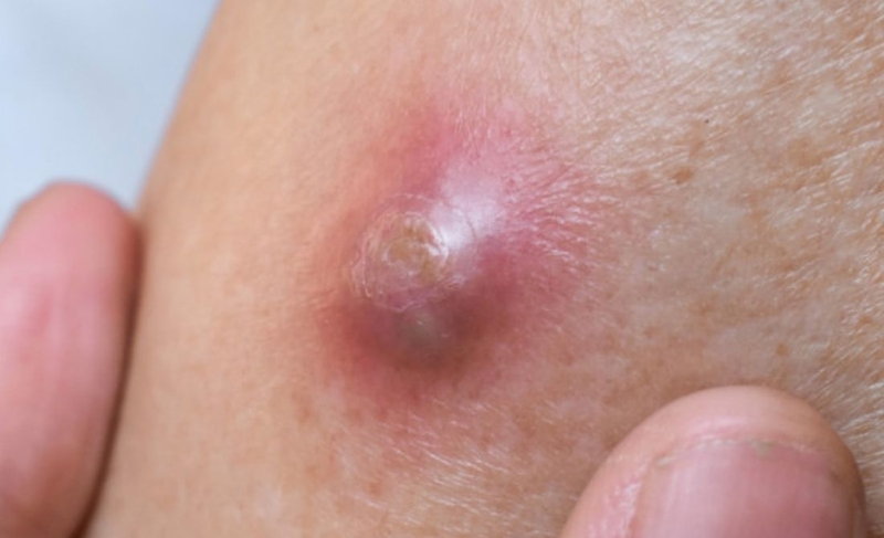 Nên làm gì khi bị mụn nhọt ở mũi 3