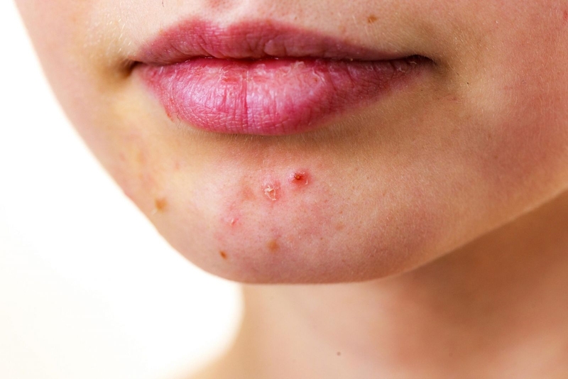 Mụn nội tiết là gì? Cách chữa dứt điểm mụn nội tiết 4