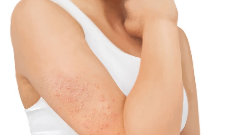 Mụn ở bắp tay: Nguyên nhân, triệu chứng, cách điều trị 1