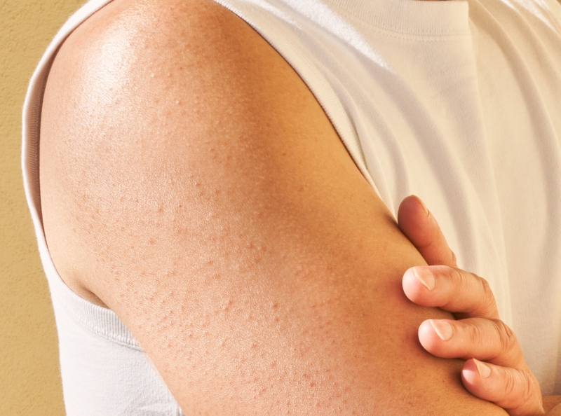 Mụn ở bắp tay: Nguyên nhân, triệu chứng, cách điều trị 2