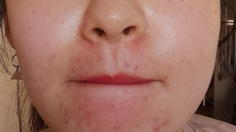 Mụn ở nhân trung – Nguyên nhân và cách điều trị mụn nhân trung 3