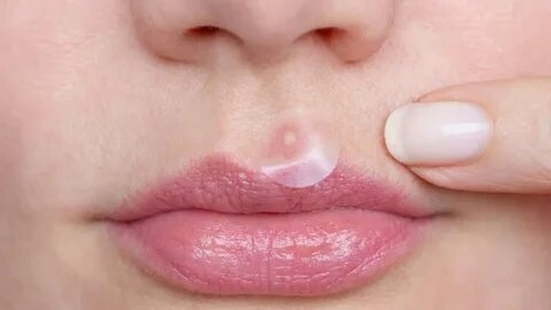 Mụn ở nhân trung – Nguyên nhân và cách điều trị mụn nhân trung 5