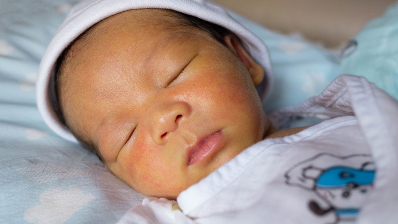 Mụn pustular melanosis là bệnh tăng sắc tố mụn mủ thoáng qua ở trẻ sơ sinh