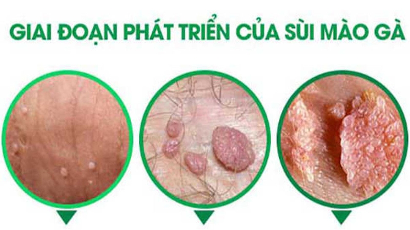 Mụn rộp sinh dục giai đoạn đầu có điều trị được không? Dấu hiệu nhận biết và phương pháp điều trị hiệu quả 4
