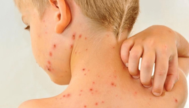 Cách nhận biết dấu hiệu của bệnh sởi, mụn sởi như thế nào 3