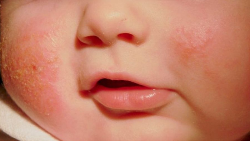 Mụn sữa ở trẻ sơ sinh khi nào hết? 4 cách điều trị mụn sữa hiệu quả 1