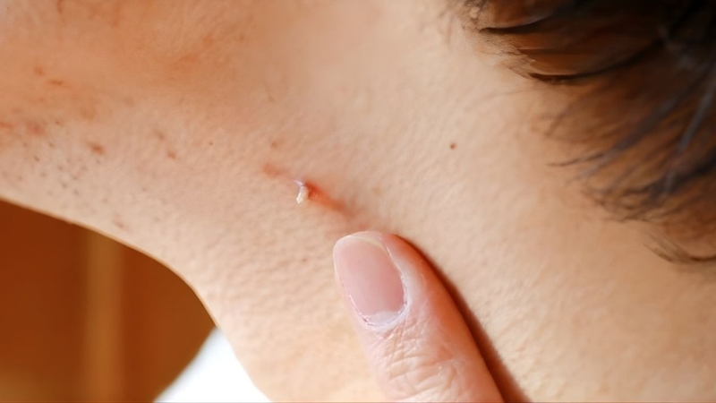 Mụn thịt có lây không&nbsp;là thắc mắc của nhiều người