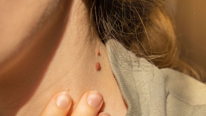 Mụn thịt có thể phát triển về kích thước theo thời gian