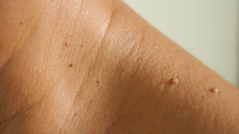 Mụn thịt hoàn toàn có thể phát triển nhiều hơn và tái phát