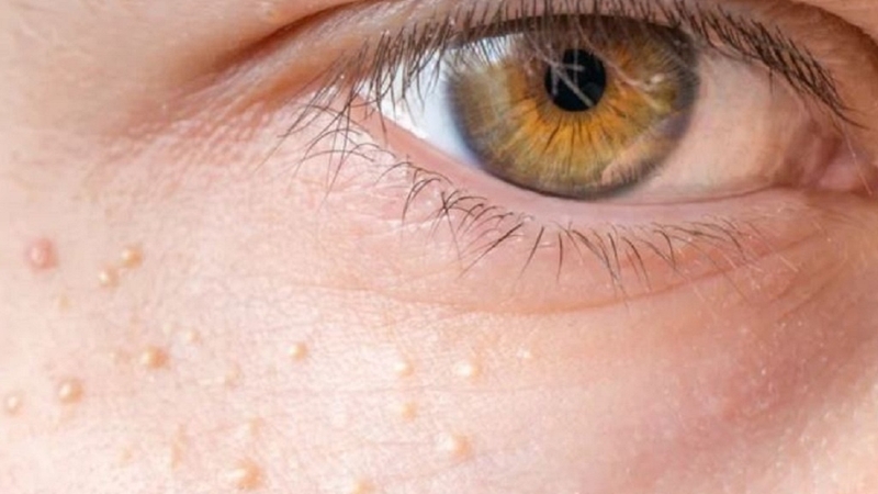 Mụn thịt khi mang thai: Nguyên nhân và cách điều trị an toàn 1