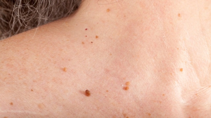 Mụn thịt khi mang thai: Nguyên nhân và cách điều trị an toàn 3