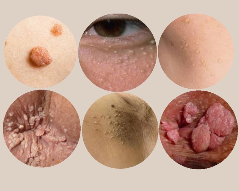 Mụn thịt là gì? Mụn thịt có gây ra biến chứng không? 3