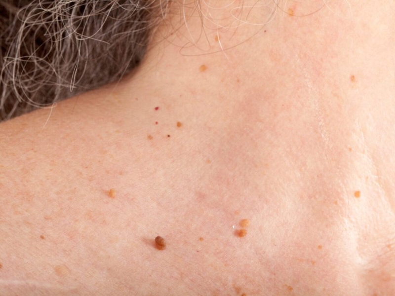 Mụn thịt ở lưng có dạng những nốt nhỏ sần trên bề mặt da của lưng