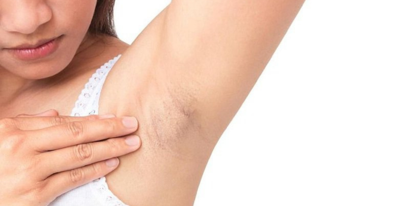 Nguyên nhân chính gây ra mụn thịt ở nách&nbsp;chủ yếu là do rối loạn bài tiết của tuyến mồ hôi