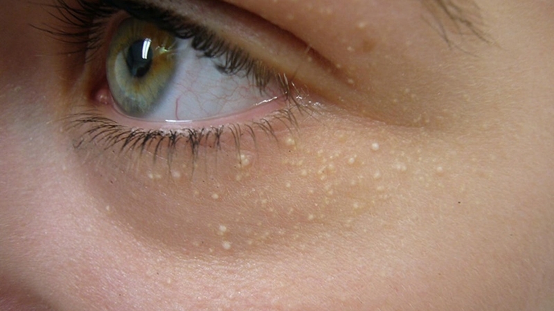 Mụn thịt ở trẻ em: Nguyên nhân, dấu hiệu và phương pháp điều trị 1