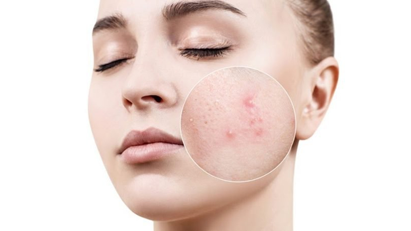 Mụn trứng cá bọc do chủng vi khuẩn P.acnes tác động sâu vào bên trong da