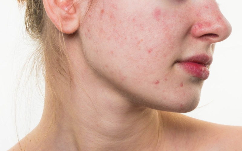 Mụn trứng cá hai bên má là gì?1