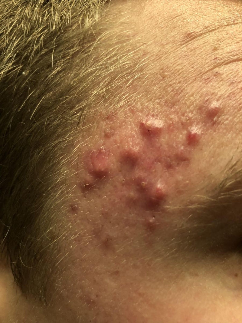 Mụn trứng cá hai bên thái dương có nguy hiểm không?1