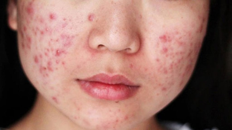 Mụn trứng cá mủ: Đặc điểm và cách điều trị khoa học 1
