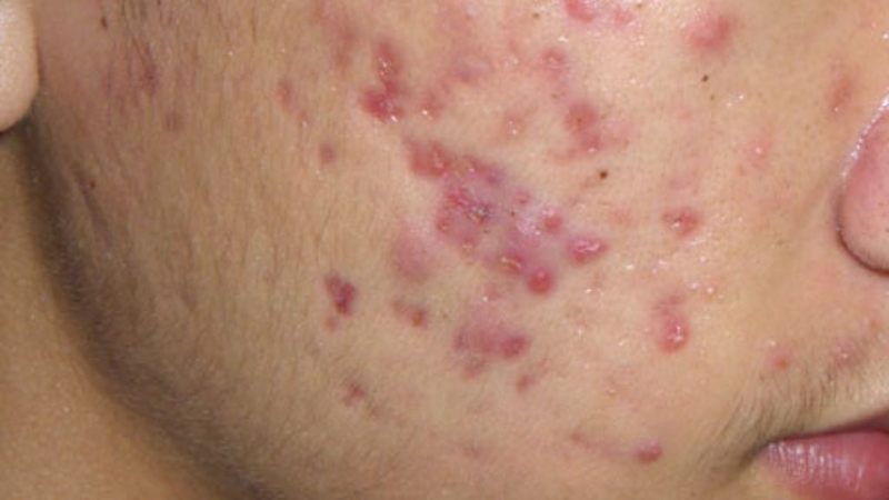 Mụn trứng cá mủ: Đặc điểm và cách điều trị khoa học 2