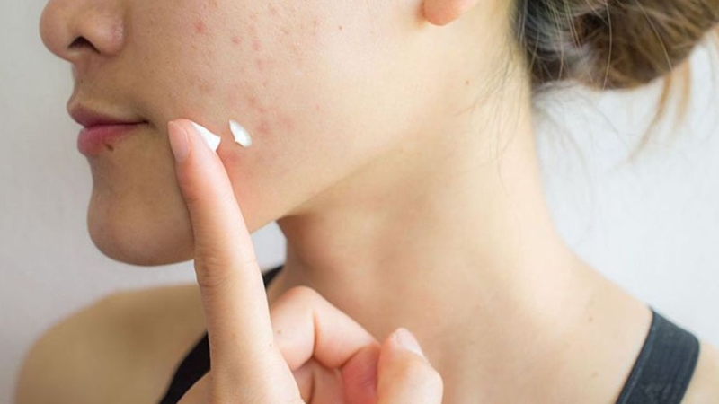 Mụn trứng cá mủ: Đặc điểm và cách điều trị khoa học 3
