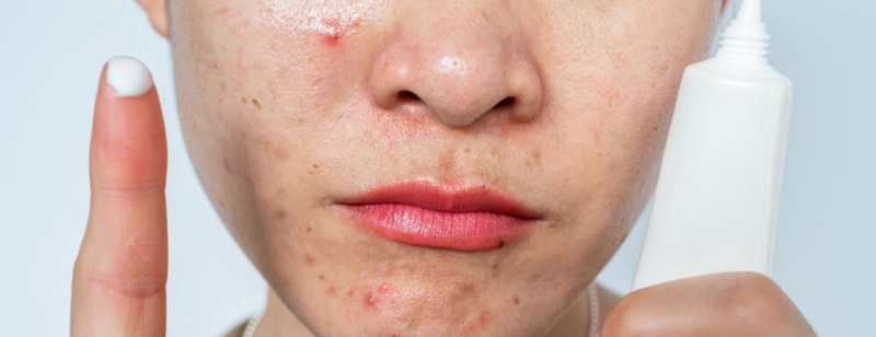 mụn trứng cá nặng 3