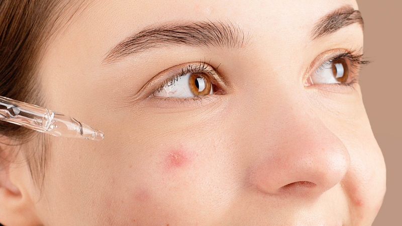 Mụn viêm có nên dùng BHA không? BHA có tốt cho da mụn? 4