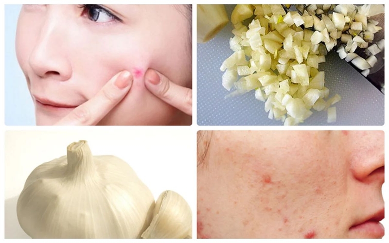 Nguyên nhân gây ra mụn viêm đỏ ở má và cách điều trị 3